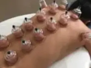A person is getting their body waxed with many small cups.